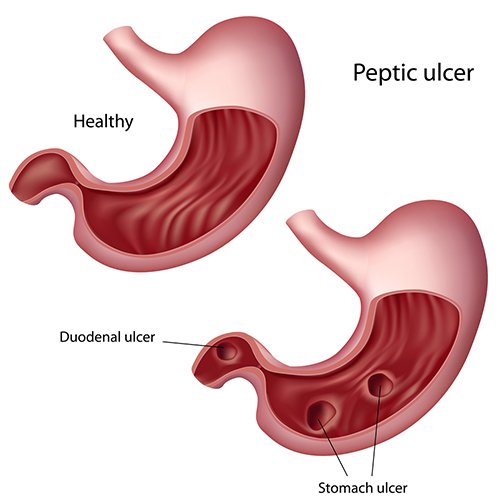 food-for-ulcer-patients-in-nigeria-thrive-well-zone